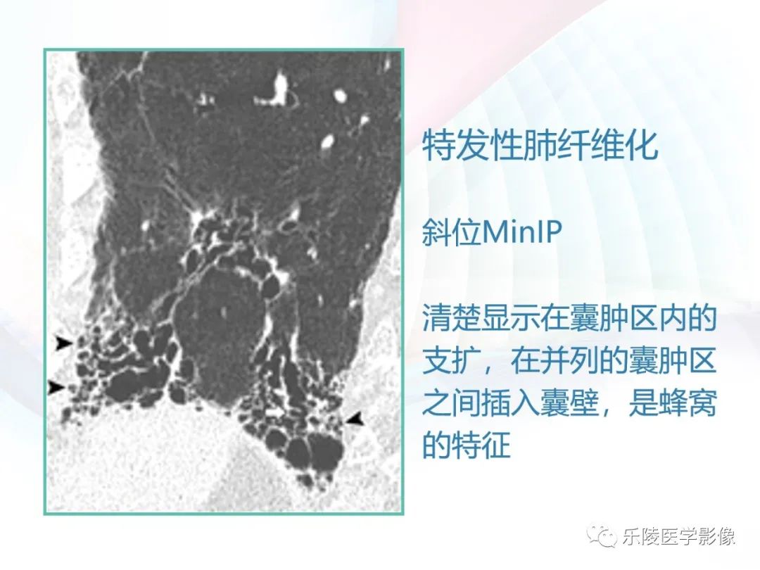 影像PPT - 【PPT】肺弥漫性病变HRCT表现-36