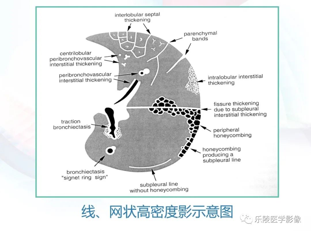 影像PPT - 【PPT】肺弥漫性病变HRCT表现-39