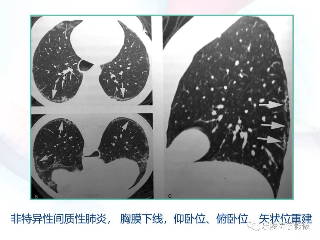 影像PPT - 【PPT】肺弥漫性病变HRCT表现-38