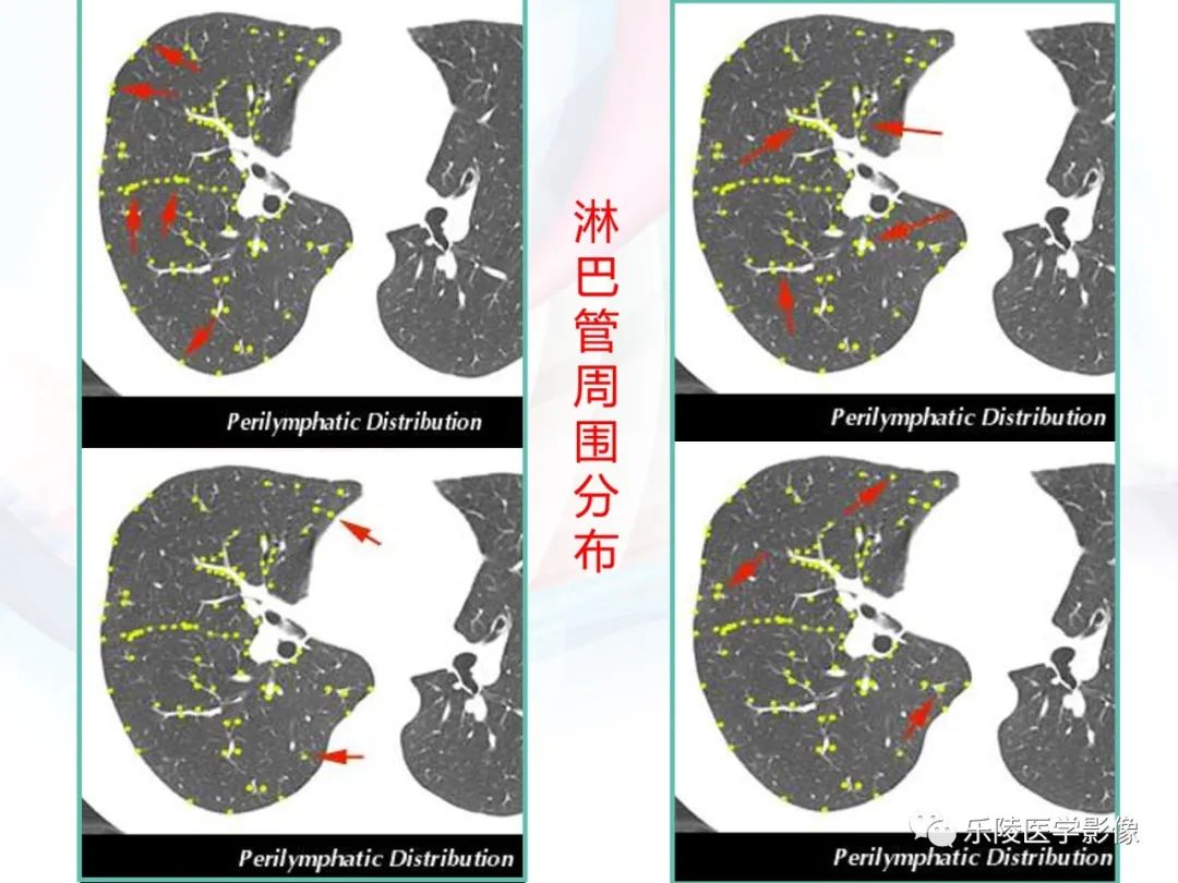 影像PPT - 【PPT】肺弥漫性病变HRCT表现-42