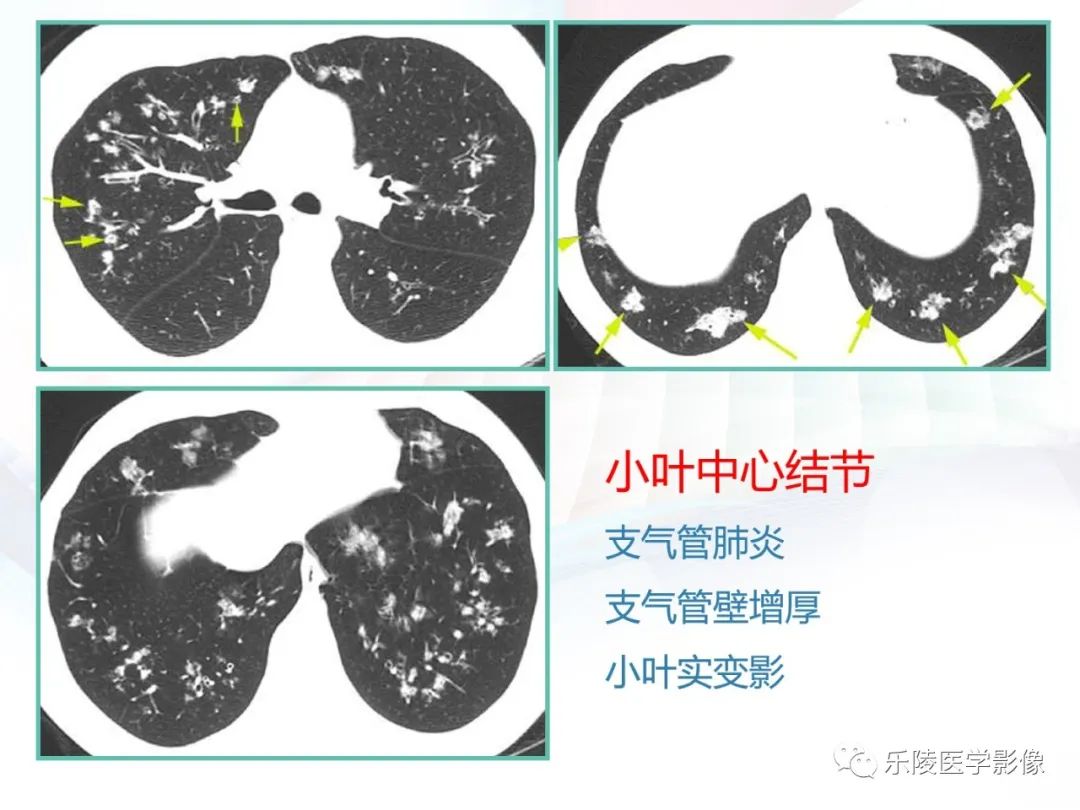 影像PPT - 【PPT】肺弥漫性病变HRCT表现-49