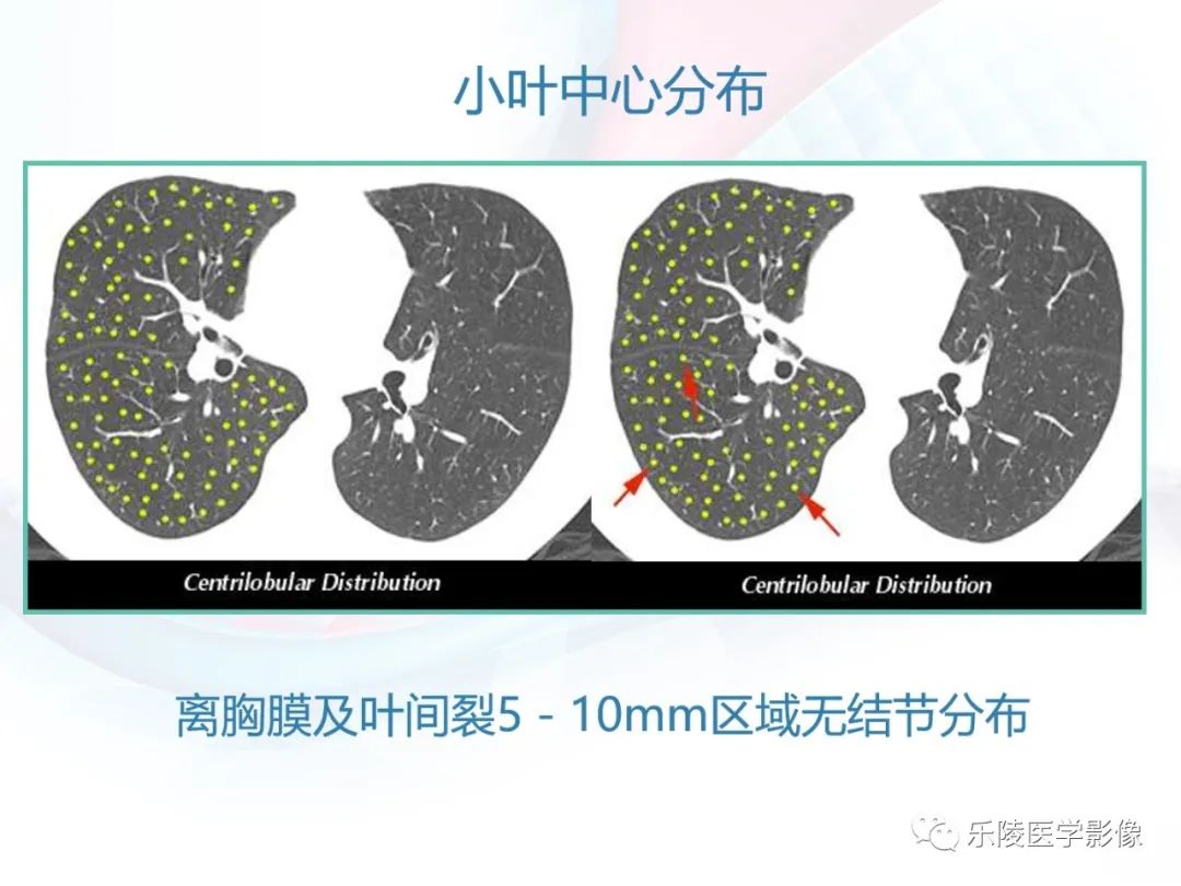 影像PPT - 【PPT】肺弥漫性病变HRCT表现-46