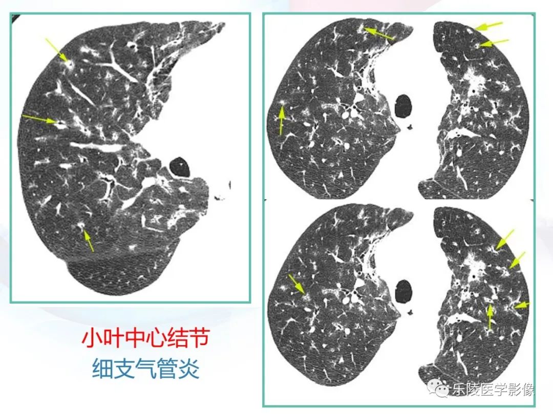 影像PPT - 【PPT】肺弥漫性病变HRCT表现-48