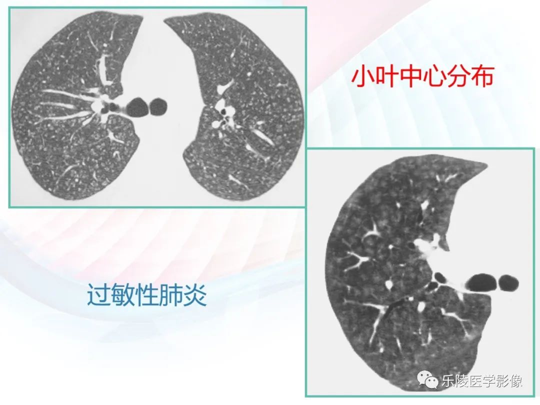 影像PPT - 【PPT】肺弥漫性病变HRCT表现-47