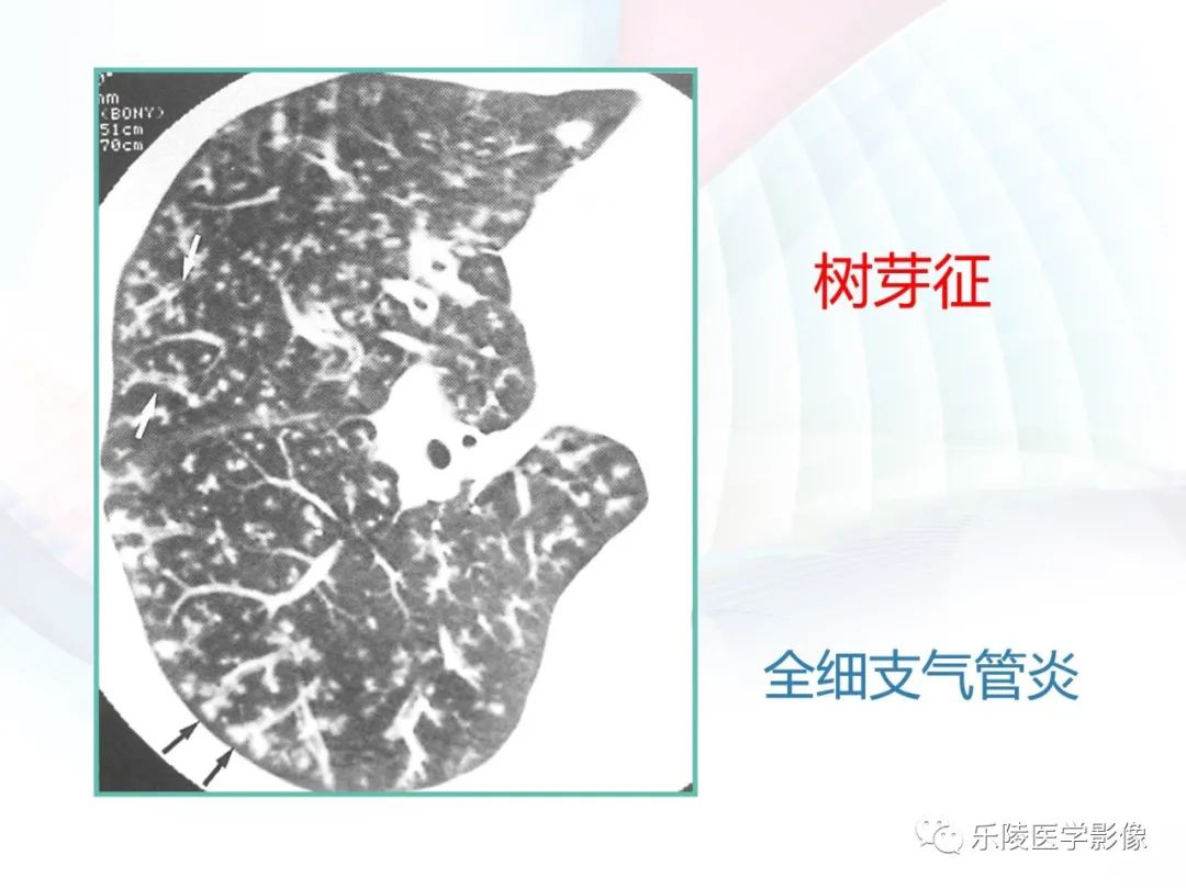 影像PPT - 【PPT】肺弥漫性病变HRCT表现-50