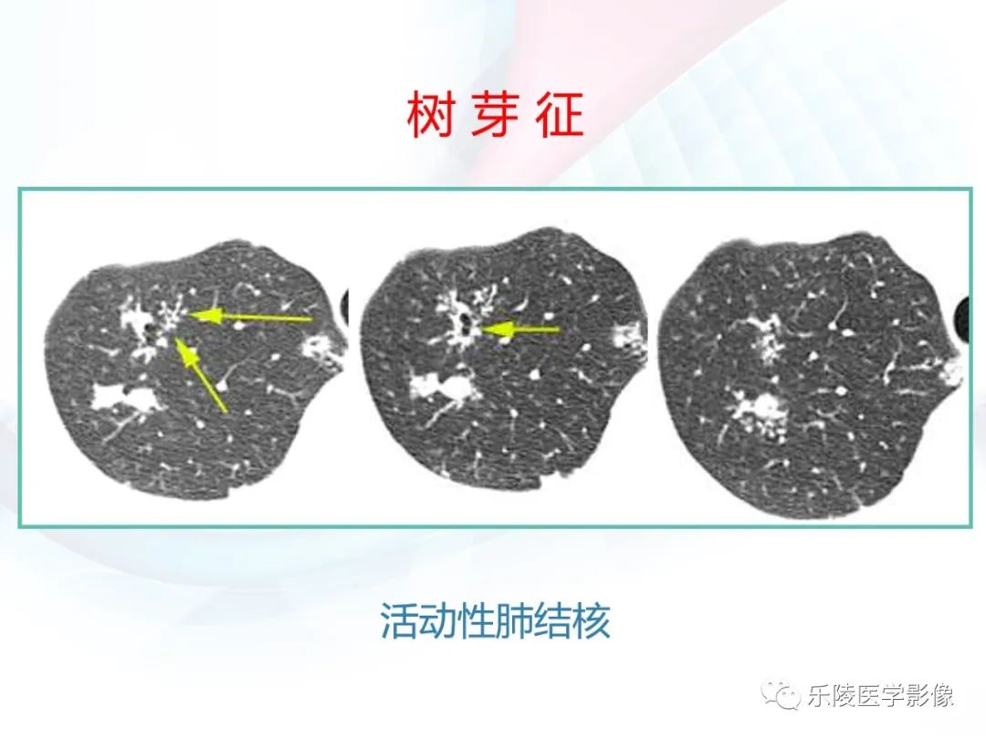 影像PPT - 【PPT】肺弥漫性病变HRCT表现-51