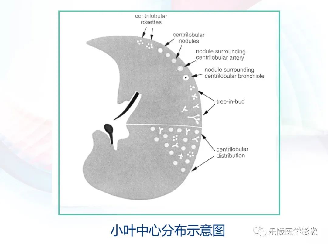 影像PPT - 【PPT】肺弥漫性病变HRCT表现-52