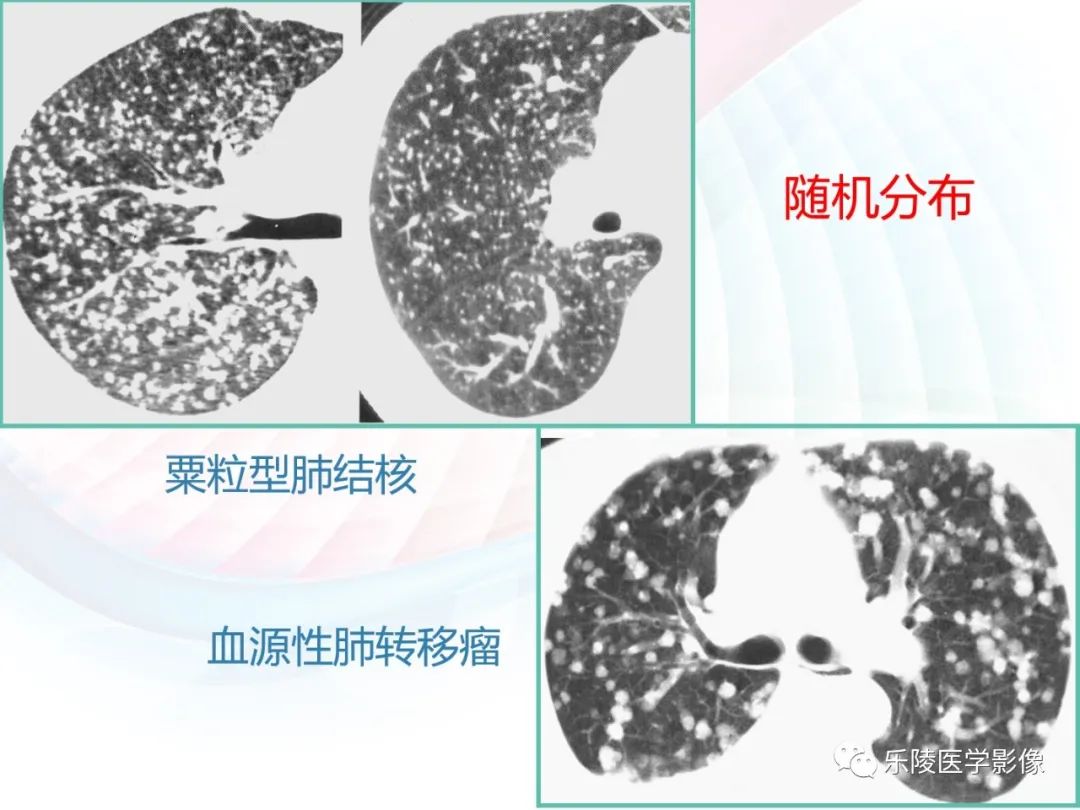 影像PPT - 【PPT】肺弥漫性病变HRCT表现-55