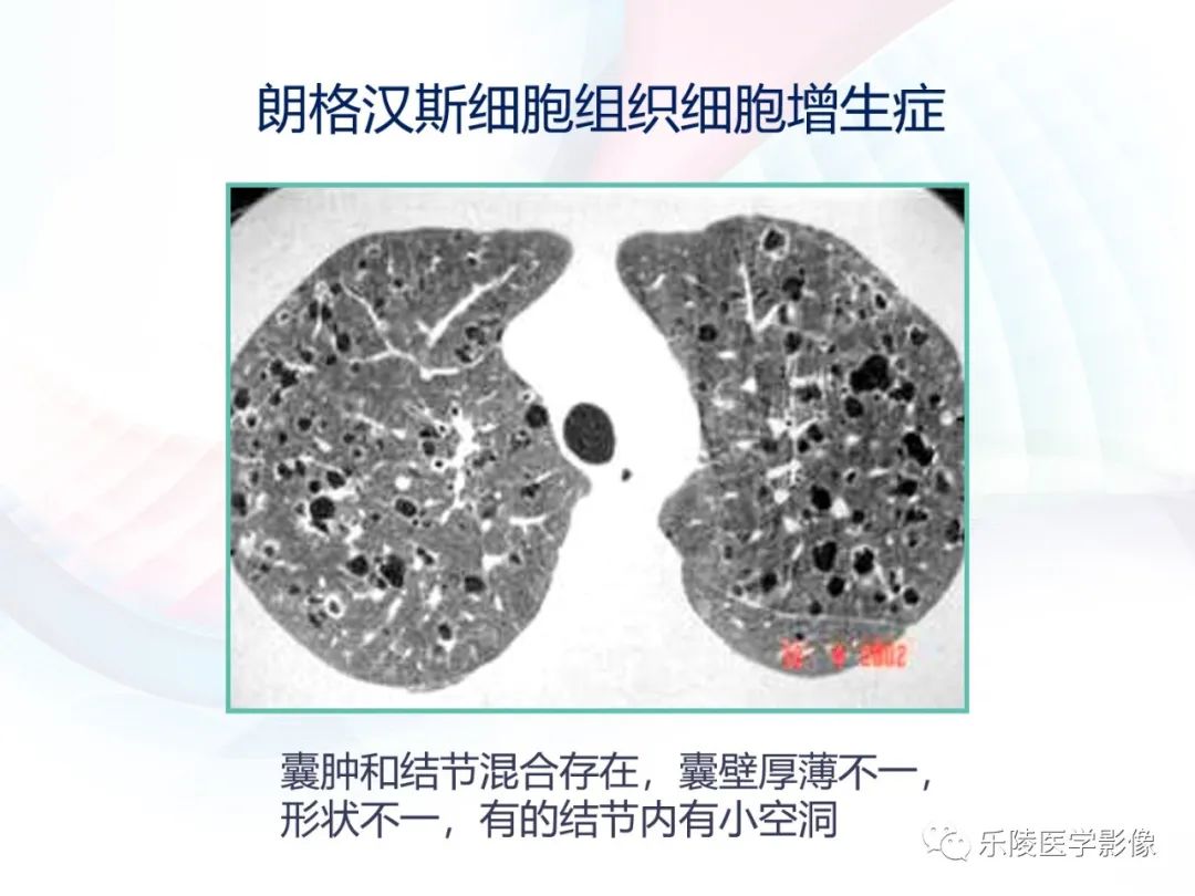 影像PPT - 【PPT】肺弥漫性病变HRCT表现-63