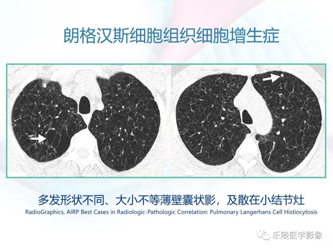 影像PPT - 【PPT】肺弥漫性病变HRCT表现-62
