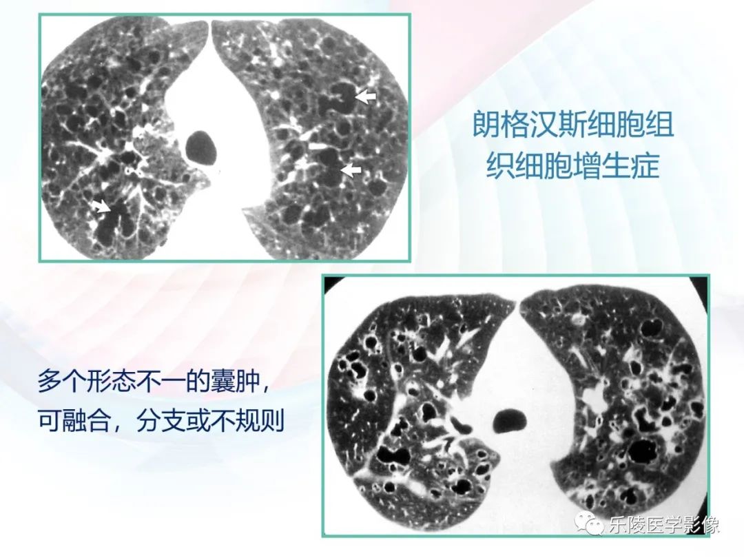 影像PPT - 【PPT】肺弥漫性病变HRCT表现-64