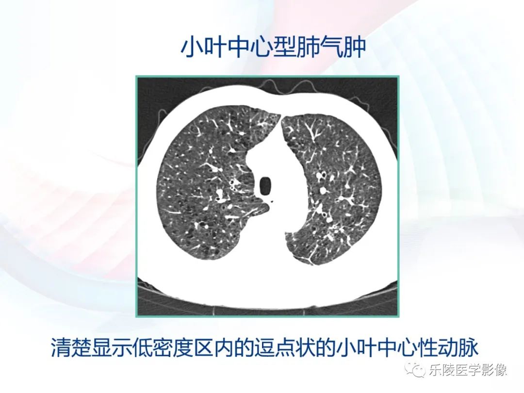 影像PPT - 【PPT】肺弥漫性病变HRCT表现-69