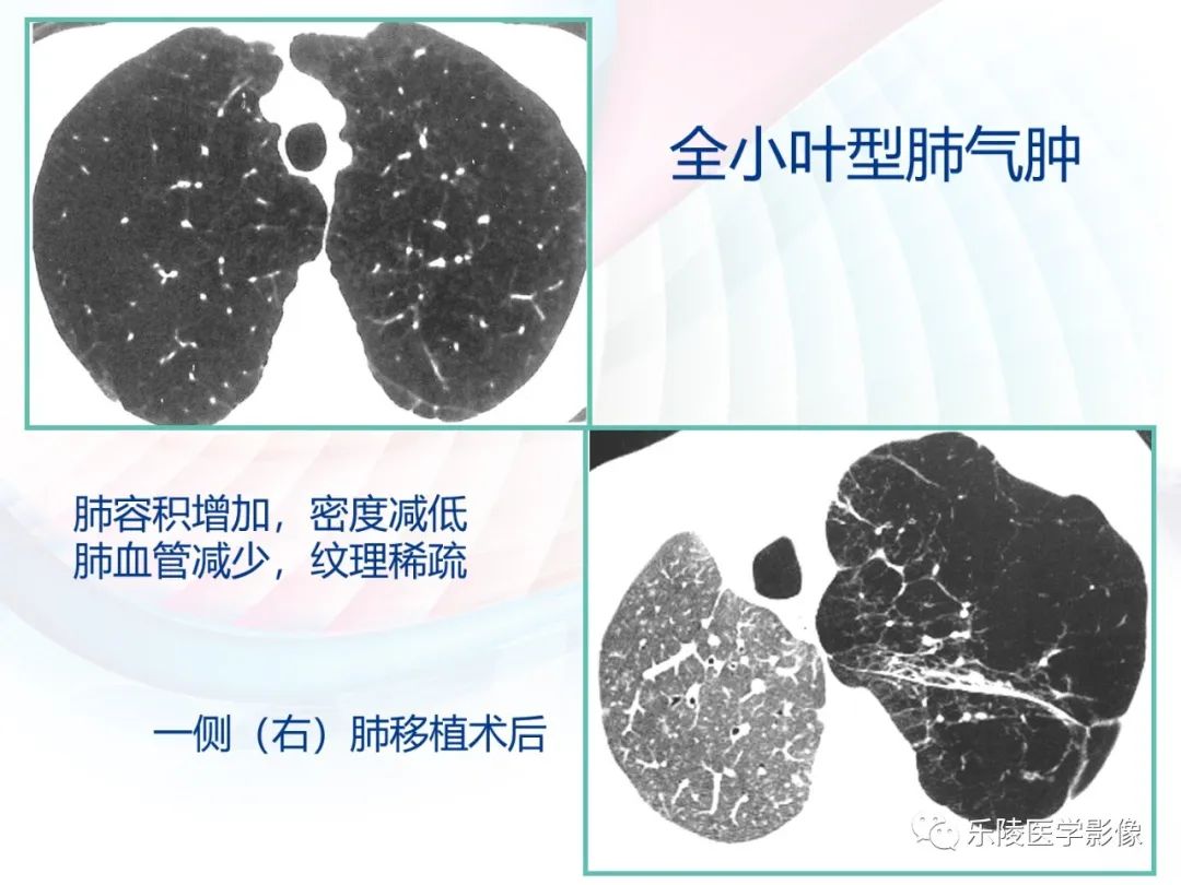 影像PPT - 【PPT】肺弥漫性病变HRCT表现-70