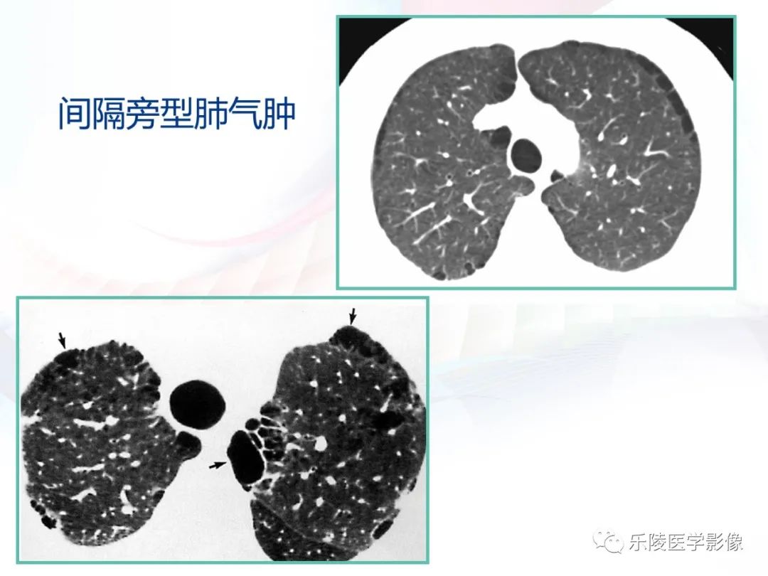 影像PPT - 【PPT】肺弥漫性病变HRCT表现-71