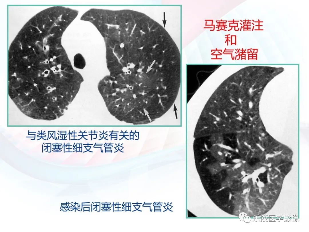 影像PPT - 【PPT】肺弥漫性病变HRCT表现-75