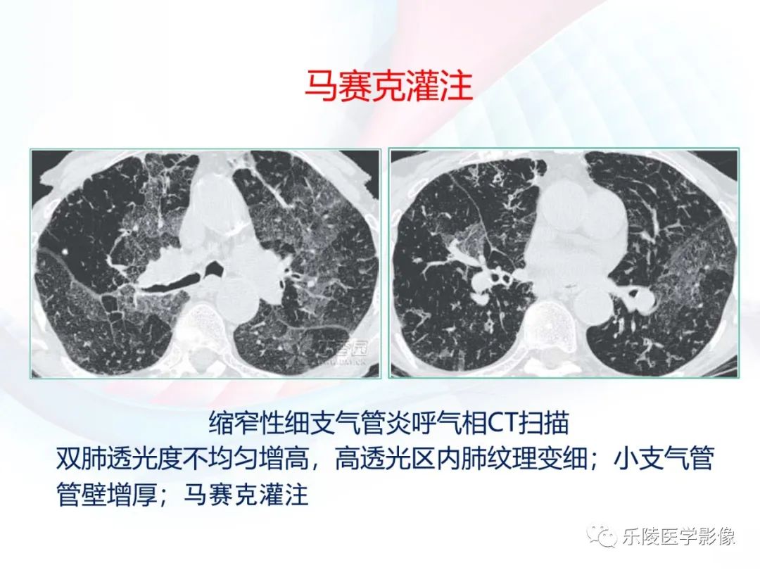 影像PPT - 【PPT】肺弥漫性病变HRCT表现-77