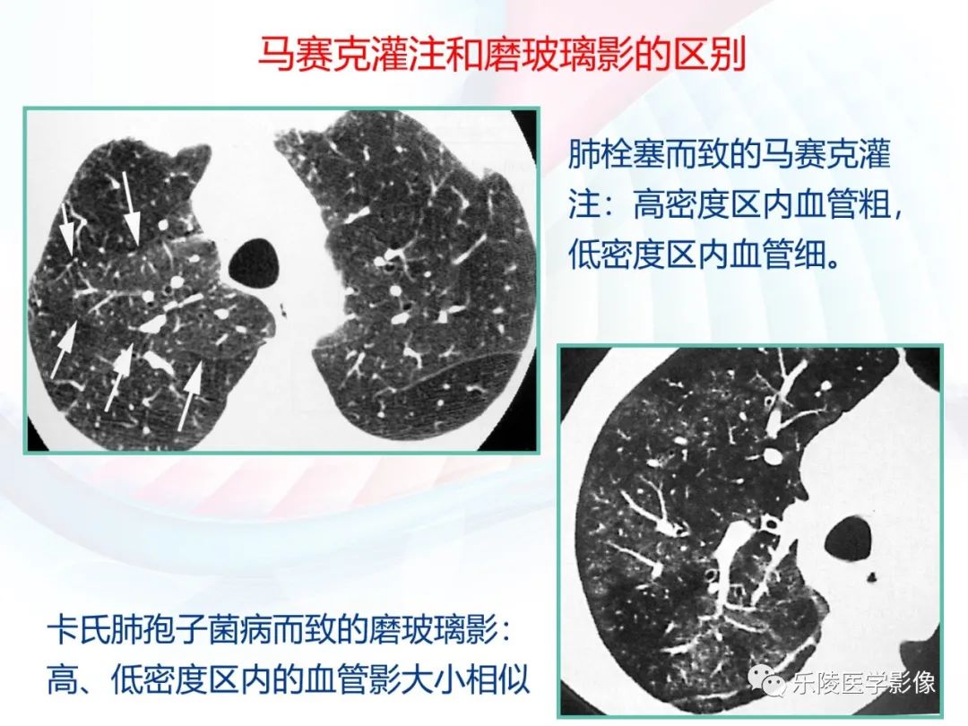 影像PPT - 【PPT】肺弥漫性病变HRCT表现-76