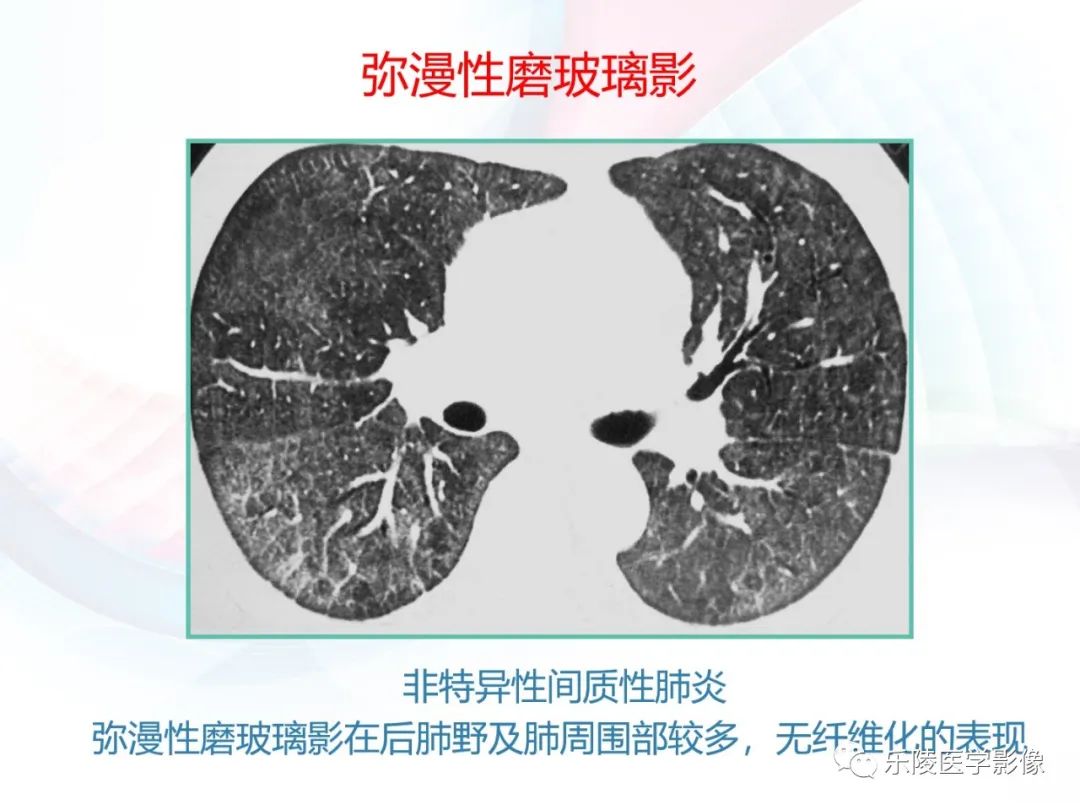 影像PPT - 【PPT】肺弥漫性病变HRCT表现-84