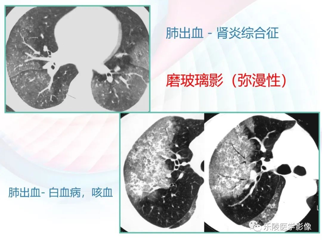 影像PPT - 【PPT】肺弥漫性病变HRCT表现-85