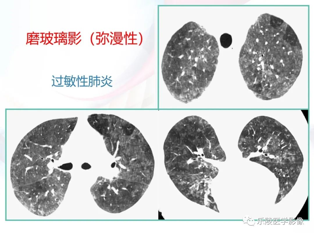影像PPT - 【PPT】肺弥漫性病变HRCT表现-86