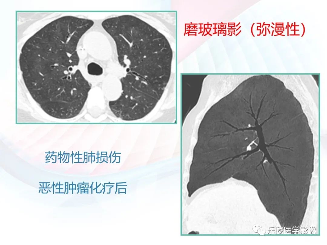 影像PPT - 【PPT】肺弥漫性病变HRCT表现-87
