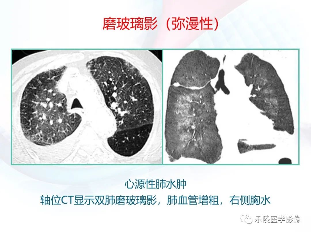 影像PPT - 【PPT】肺弥漫性病变HRCT表现-88