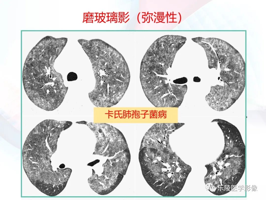 影像PPT - 【PPT】肺弥漫性病变HRCT表现-89