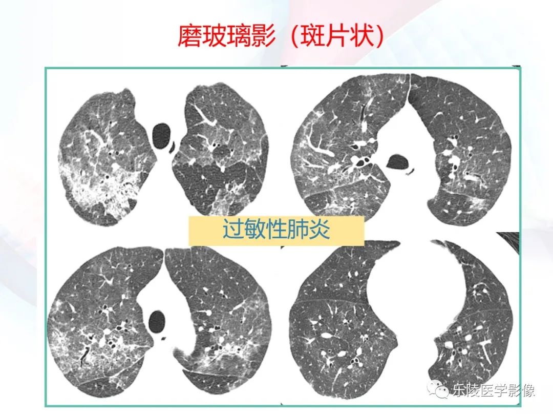 影像PPT - 【PPT】肺弥漫性病变HRCT表现-92