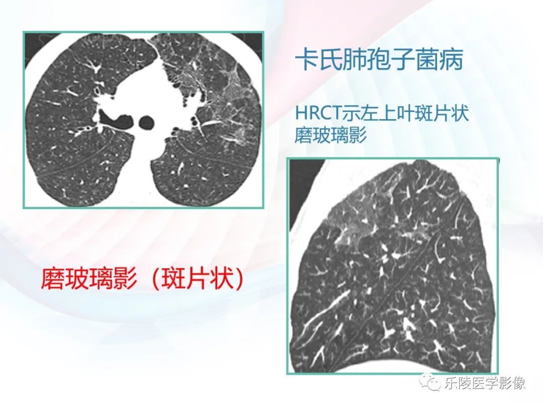 影像PPT - 【PPT】肺弥漫性病变HRCT表现-93