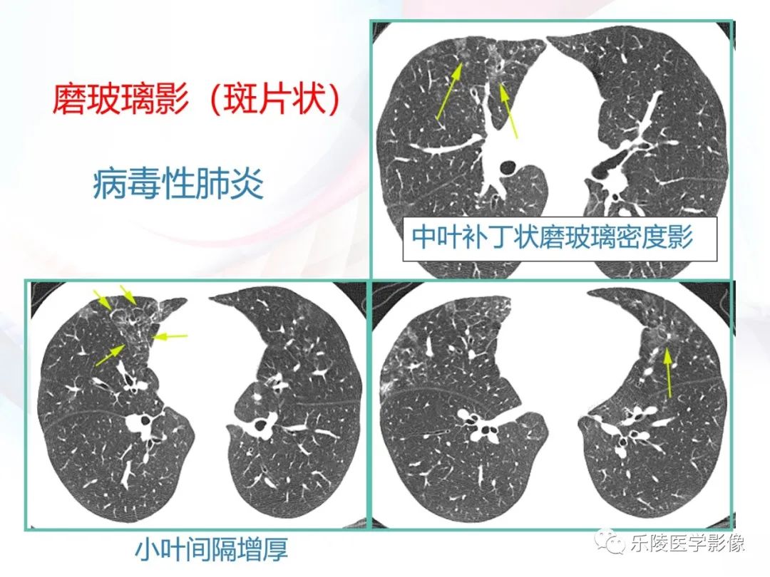 影像PPT - 【PPT】肺弥漫性病变HRCT表现-94