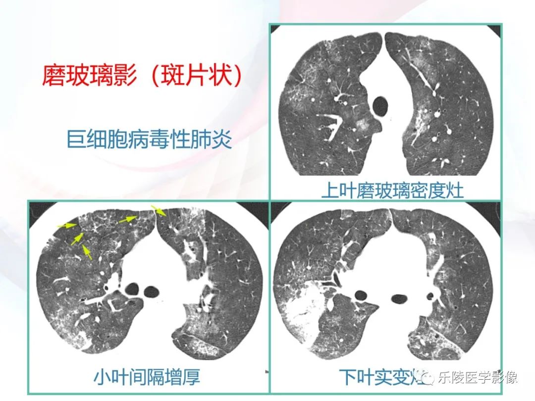 影像PPT - 【PPT】肺弥漫性病变HRCT表现-95