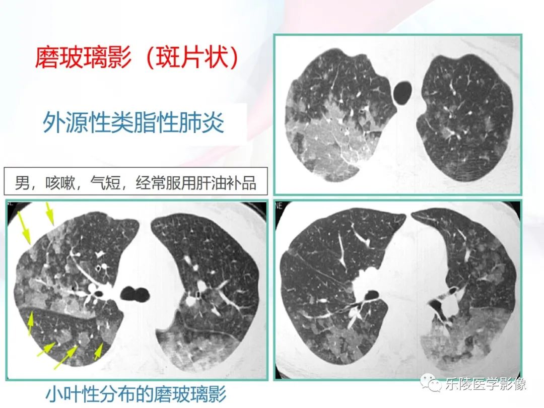 影像PPT - 【PPT】肺弥漫性病变HRCT表现-97