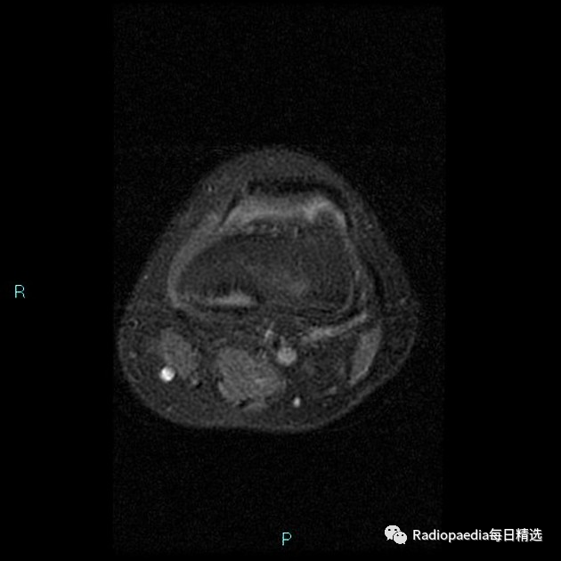 影像PPT - 【病例】股骨远端撕脱性皮质不规则1例X线MR影像-3 影像PPT - 【病例】股骨远端撕脱性皮质不规则1例X线MR影像-3