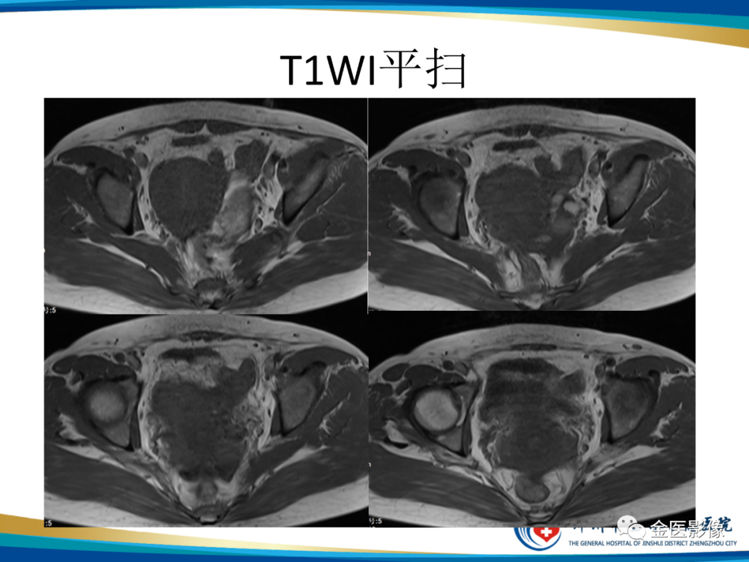影像PPT - 【PPT】输卵管脓肿-5