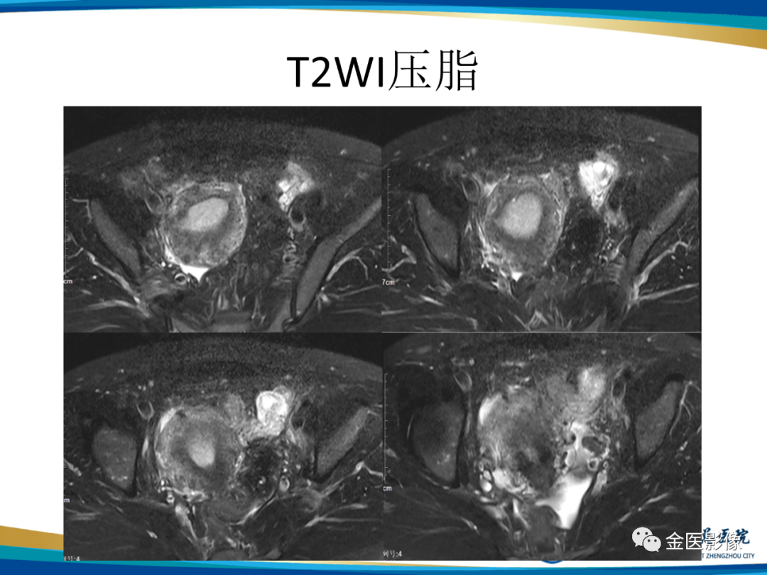 影像PPT - 【PPT】输卵管脓肿-4