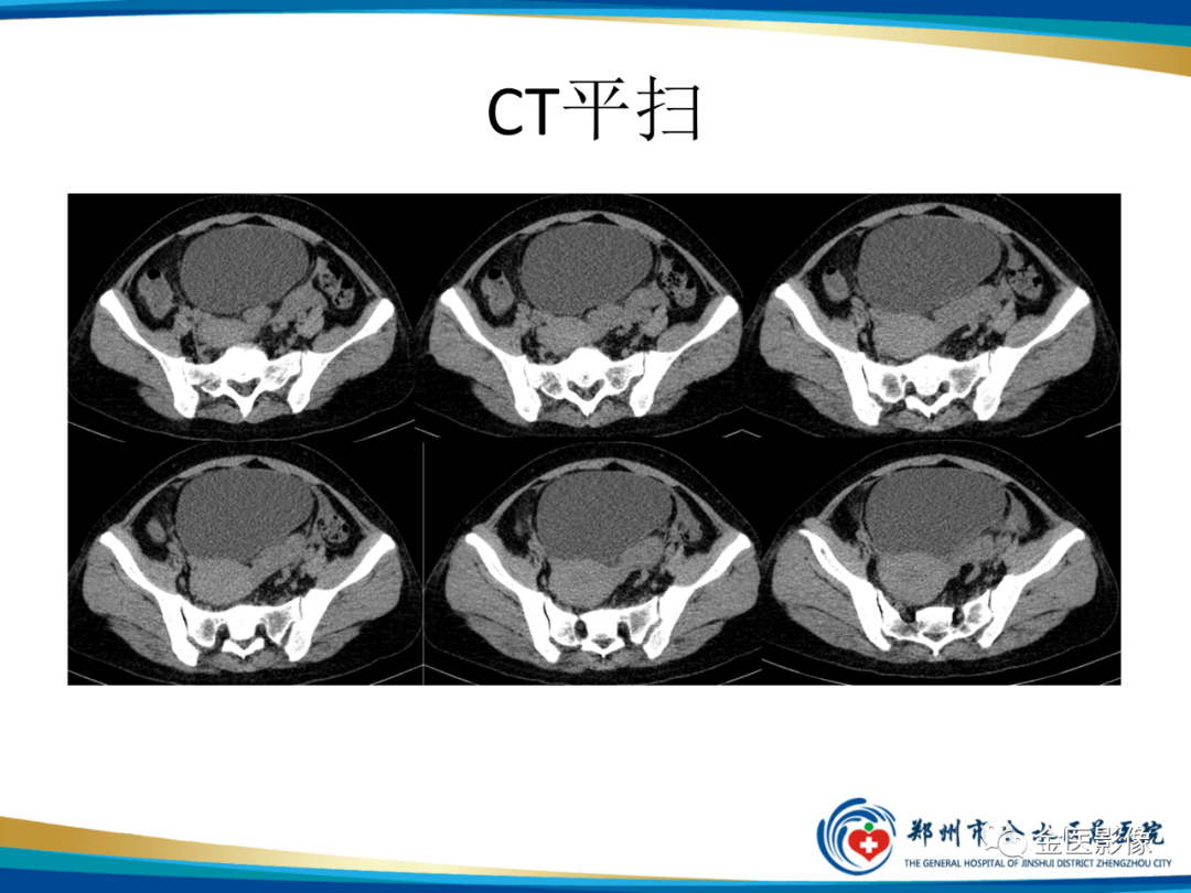 影像PPT - 【PPT】输卵管脓肿-3