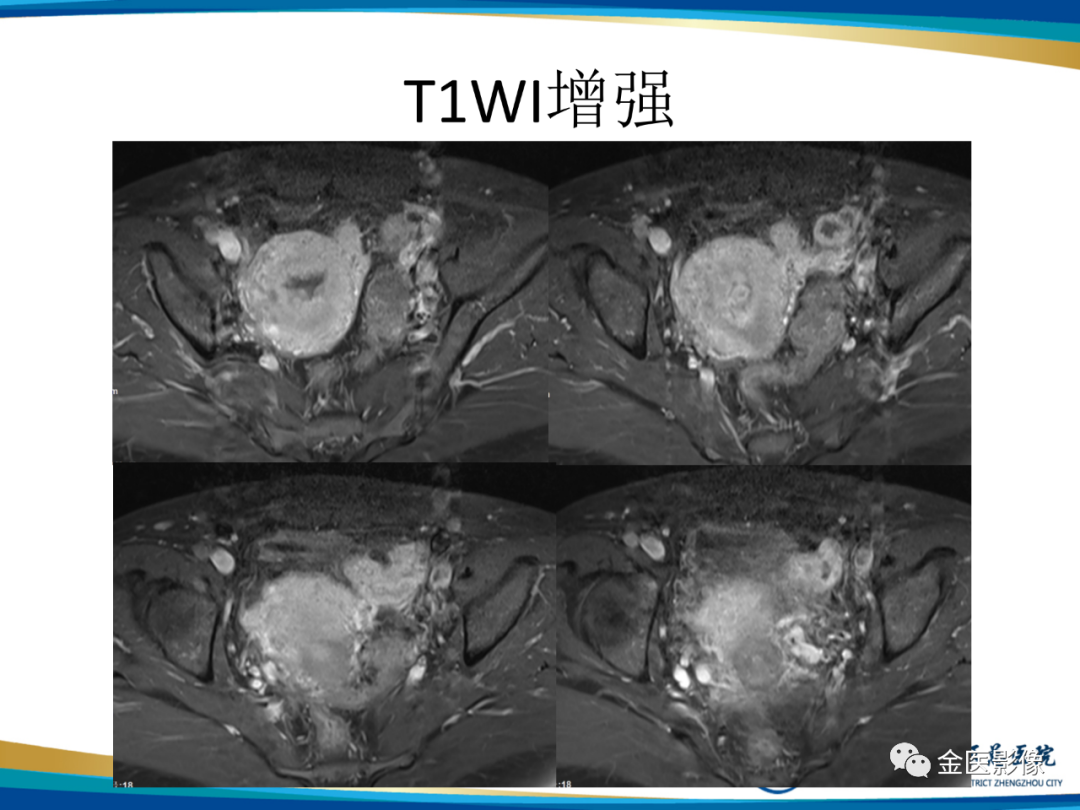 影像PPT - 【PPT】输卵管脓肿-8