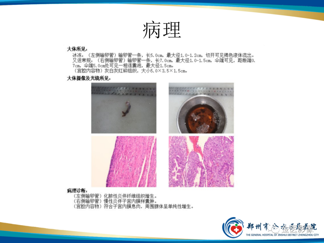 影像PPT - 【PPT】输卵管脓肿-9