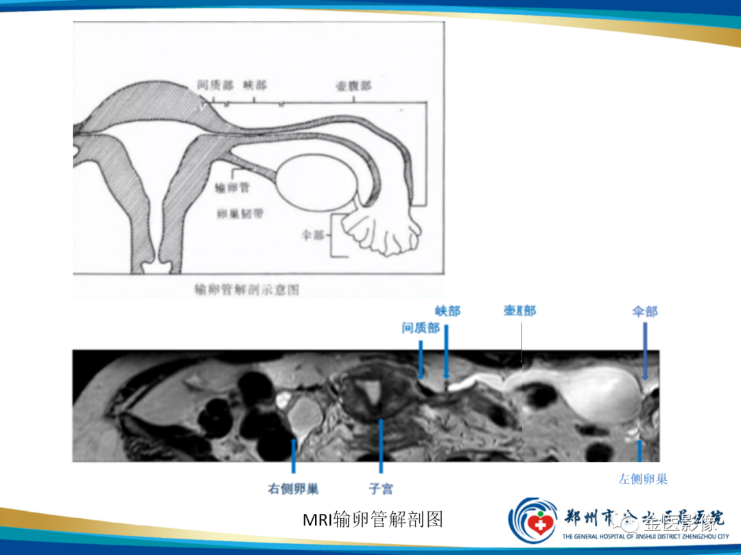 影像PPT - 【PPT】输卵管脓肿-13