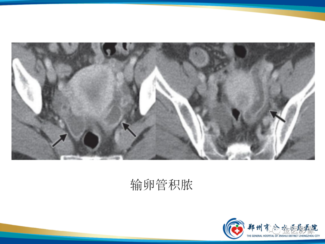影像PPT - 【PPT】输卵管脓肿-20