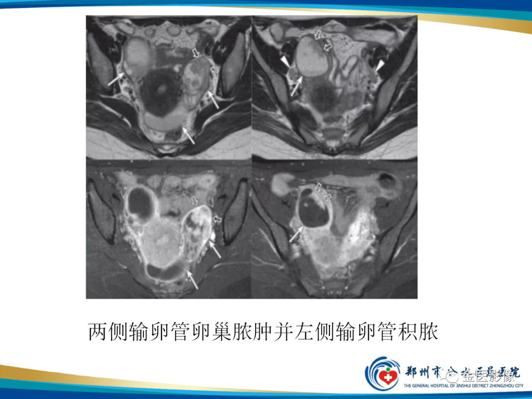 影像PPT - 【PPT】输卵管脓肿-23