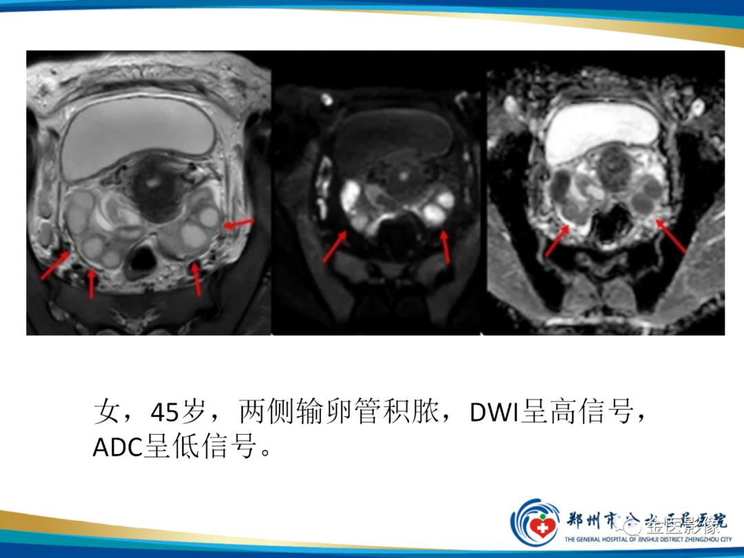 影像PPT - 【PPT】输卵管脓肿-21
