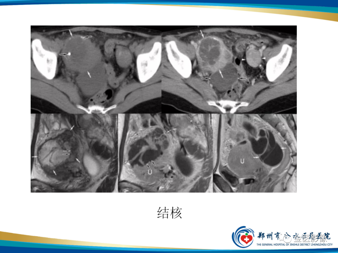 影像PPT - 【PPT】输卵管脓肿-25