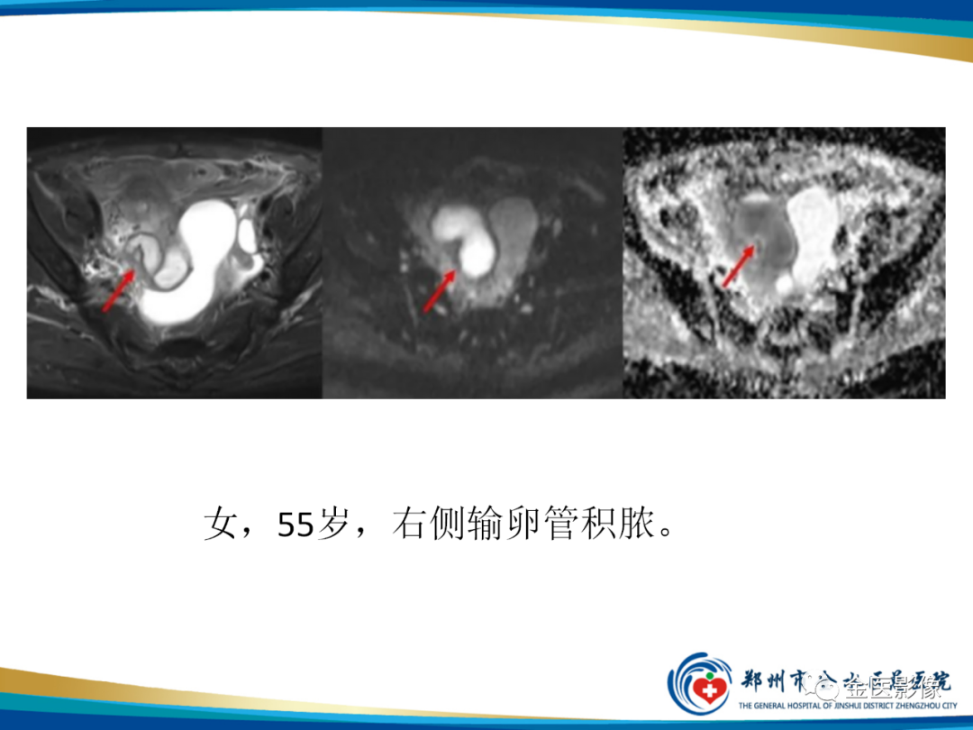 影像PPT - 【PPT】输卵管脓肿-22