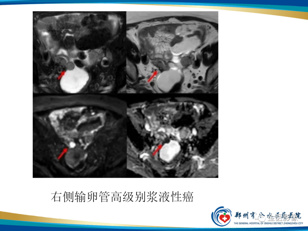 影像PPT - 【PPT】输卵管脓肿-27
