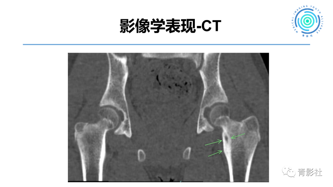 影像PPT - 【病例】股骨骨样骨瘤1例X线CT及MR影像-5