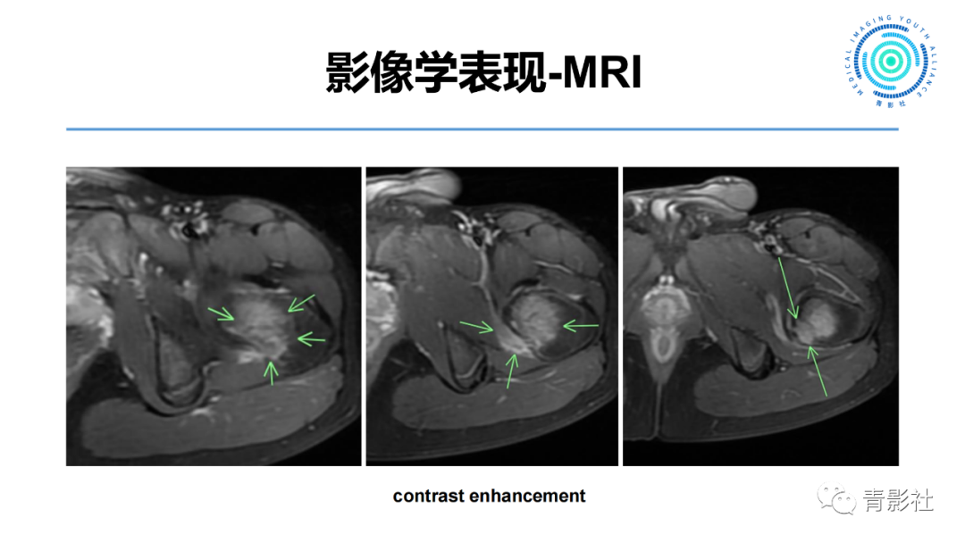 影像PPT - 【病例】股骨骨样骨瘤1例X线CT及MR影像-6
