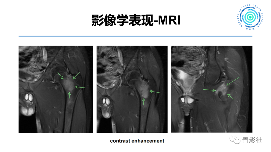 影像PPT - 【病例】股骨骨样骨瘤1例X线CT及MR影像-7