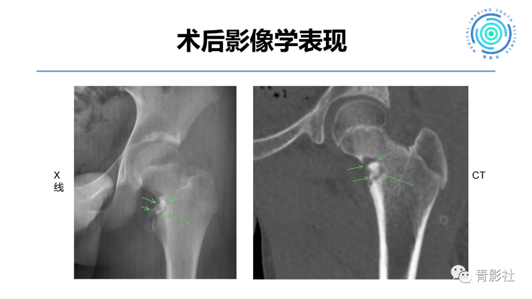 影像PPT - 【病例】股骨骨样骨瘤1例X线CT及MR影像-10