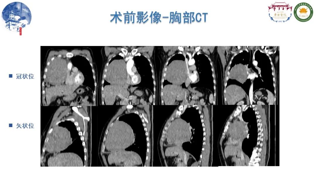 影像PPT - 【病例】纵隔大细胞神经内分泌癌1例CT影像-5